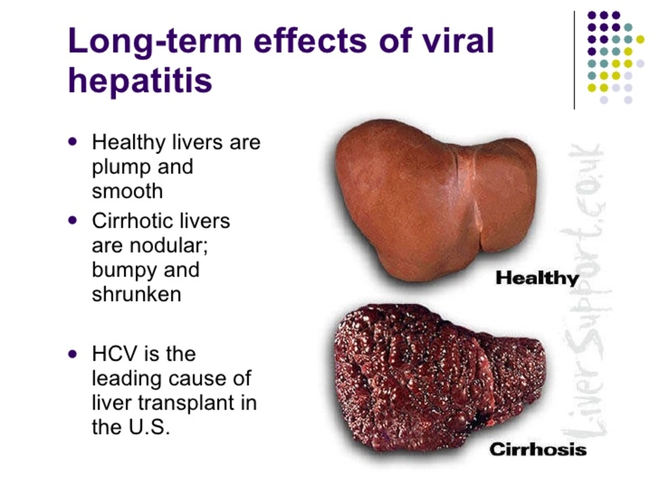 The Impact of Hepatitis C on Mental Health and Well-being