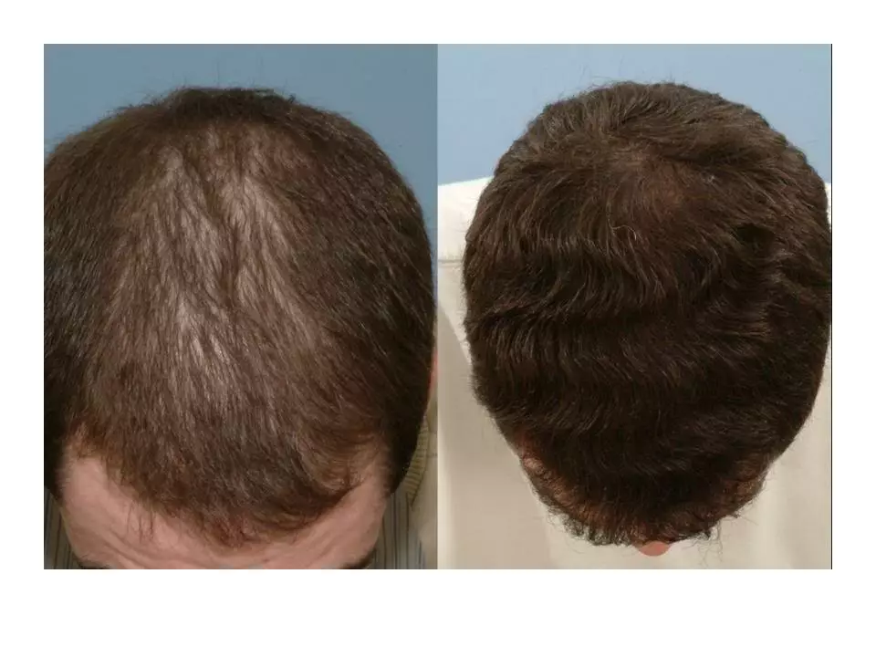 The Science Behind Finasteride: How it Works to Treat Hair Loss