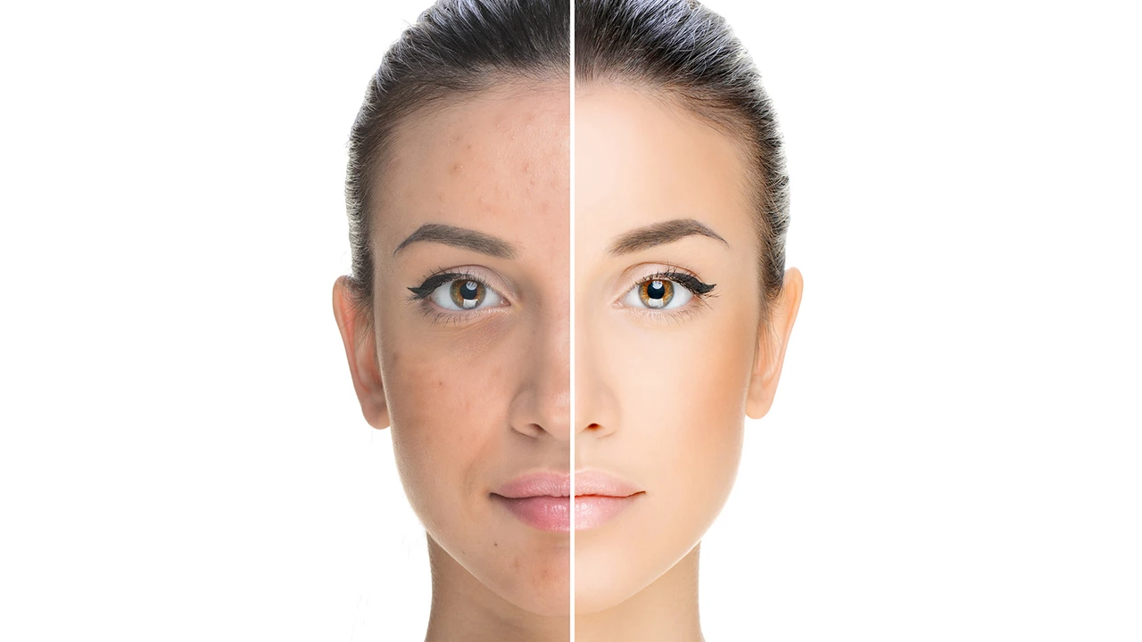The Benefits of Chemical Peels for Age Spot Removal